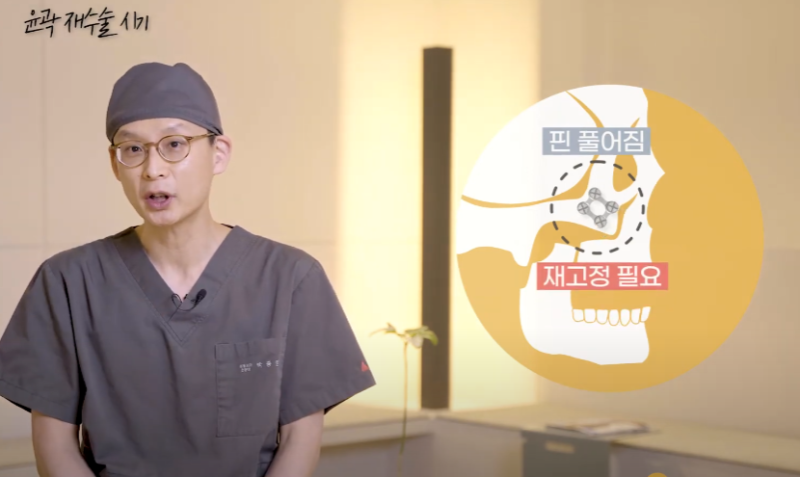 臉部輪廓重修手術的時機與原因，為何必須等待6個月？