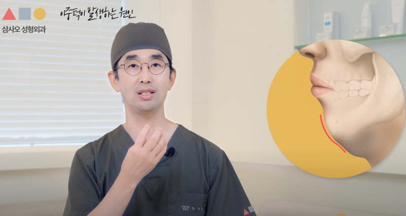 Double Chin Removal: Achieve a Smooth Jawline with Customized Solutions (Liposuction & Muscle Tying)