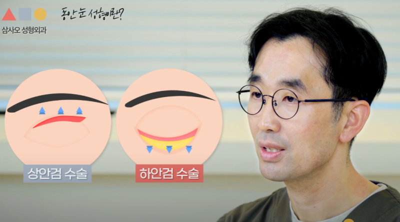 상안검 하안검 수술 차이와 주의사항, 동안 눈 성형으로 자연스러운 개선