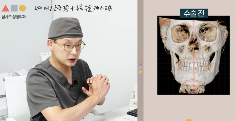 Review of 3-Point Facial Contouring and Paranasal Augmentation for Asymmetry: How to Smooth Out Bumpy Lines