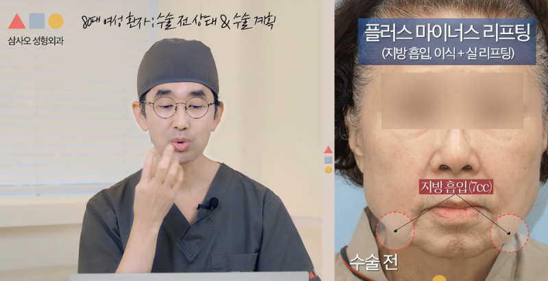Lifting for Facial Sagging in Your 80s: Plus-Minus Lifting Effects and 1-Year Progress for Natural Changes