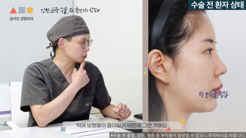 Case Review of Malar Reduction and Genioplasty: Achieving a Smooth Facial Contour
