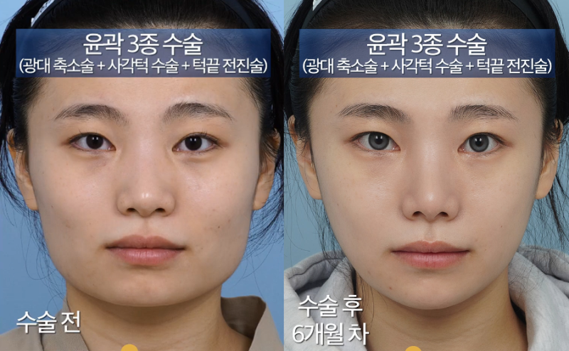 Real Case of 3-Type Facial Contouring in a Patient in Her 20s: A Smooth V-Line Achieved Through the Harmony of the Square Jaw, Cheekbones, and Chin