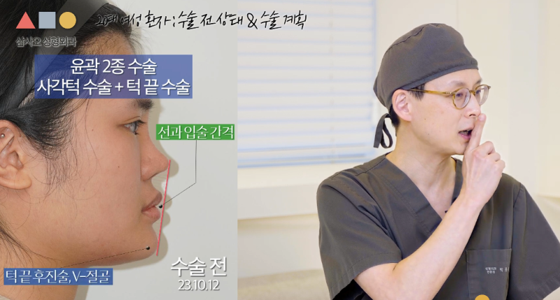 Escaping a Square Face! Real Case of a Female in Her 20s with 2-Type Facial Contouring (Square Jaw Reduction + Genioplasty)