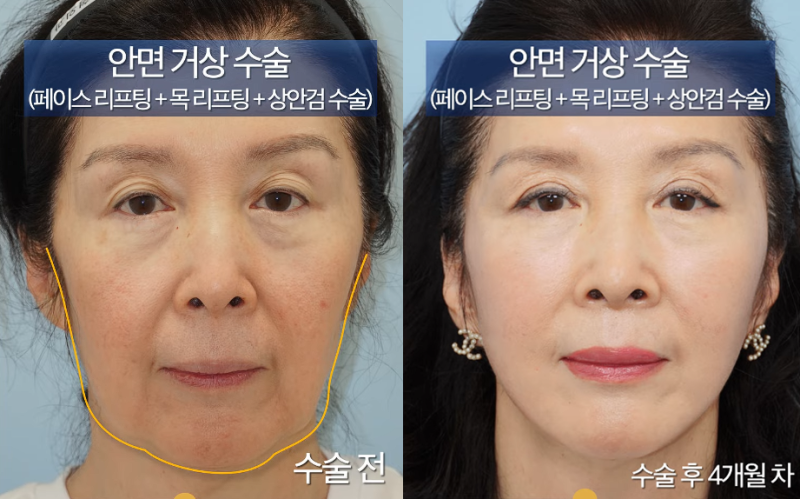 Ca phẫu thuật căng da mặt và cắt mí trên cho độ tuổi 60: Loại bỏ mỡ má xệ và nâng cơ tự nhiên