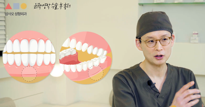 윤곽, 양악 수술 후 레이저 시술 받아도 되나요? 뼈박사가 알려드립니다 사진 9