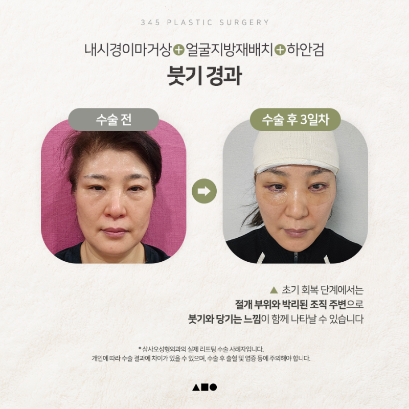 내시경이마거상 붓기, 언제 자연스러워질까요? 실제 회복 과정 공개 사진 2