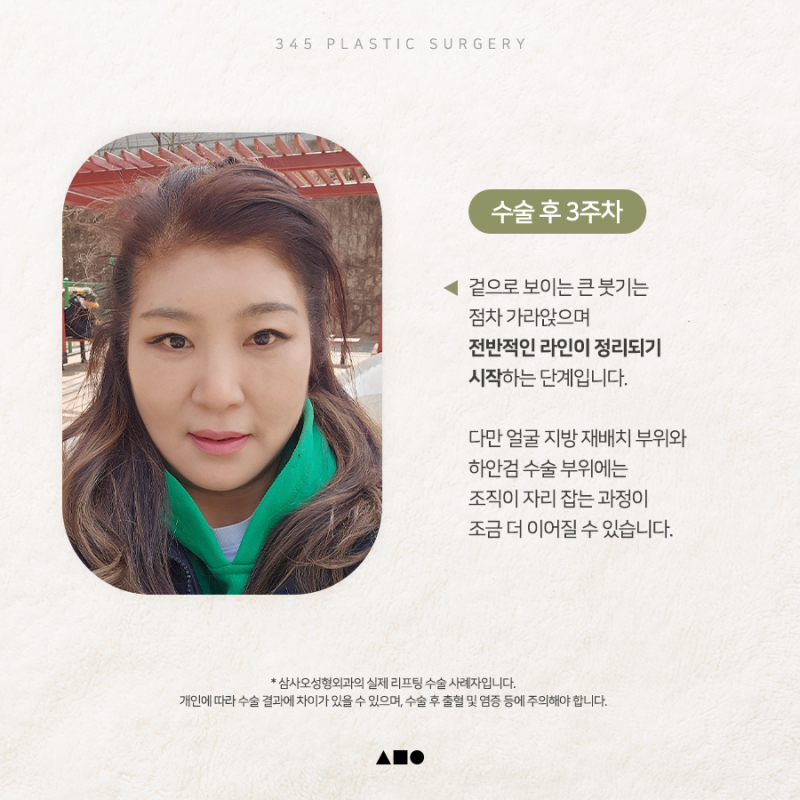 내시경이마거상 붓기, 언제 자연스러워질까요? 실제 회복 과정 공개 사진 3