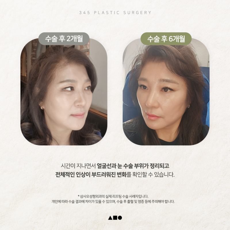 내시경이마거상 붓기, 언제 자연스러워질까요? 실제 회복 과정 공개 사진 5