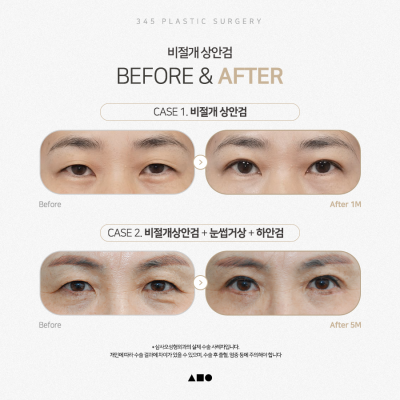 상안검 수술, 꼭 절개해야 할까요? 비절개 상안검 알아보기 사진 6