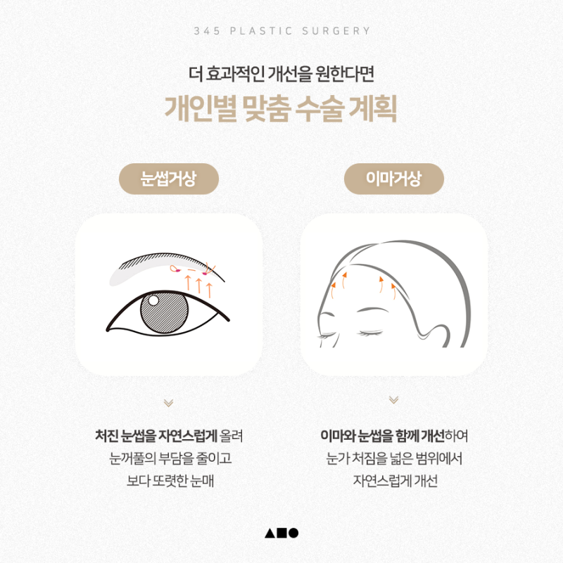 상안검 수술, 꼭 절개해야 할까요? 비절개 상안검 알아보기 사진 4