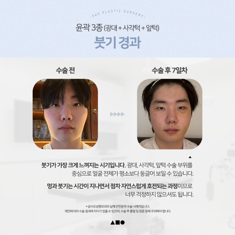 20대 남성 윤곽3종 후기, 붓기 변화 6개월 경과 사진 2