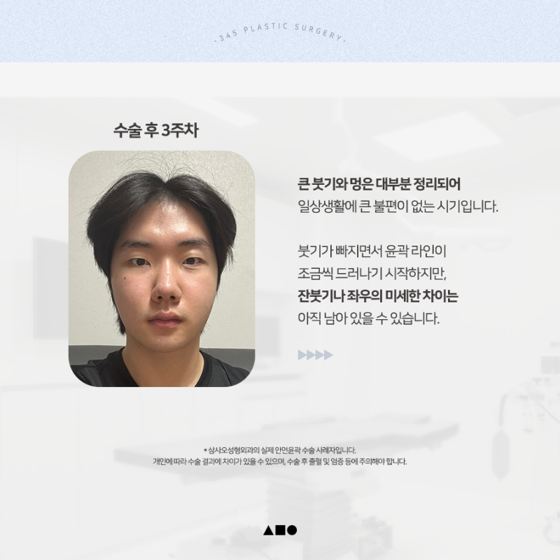 20대 남성 윤곽3종 후기, 붓기 변화 6개월 경과 사진 3