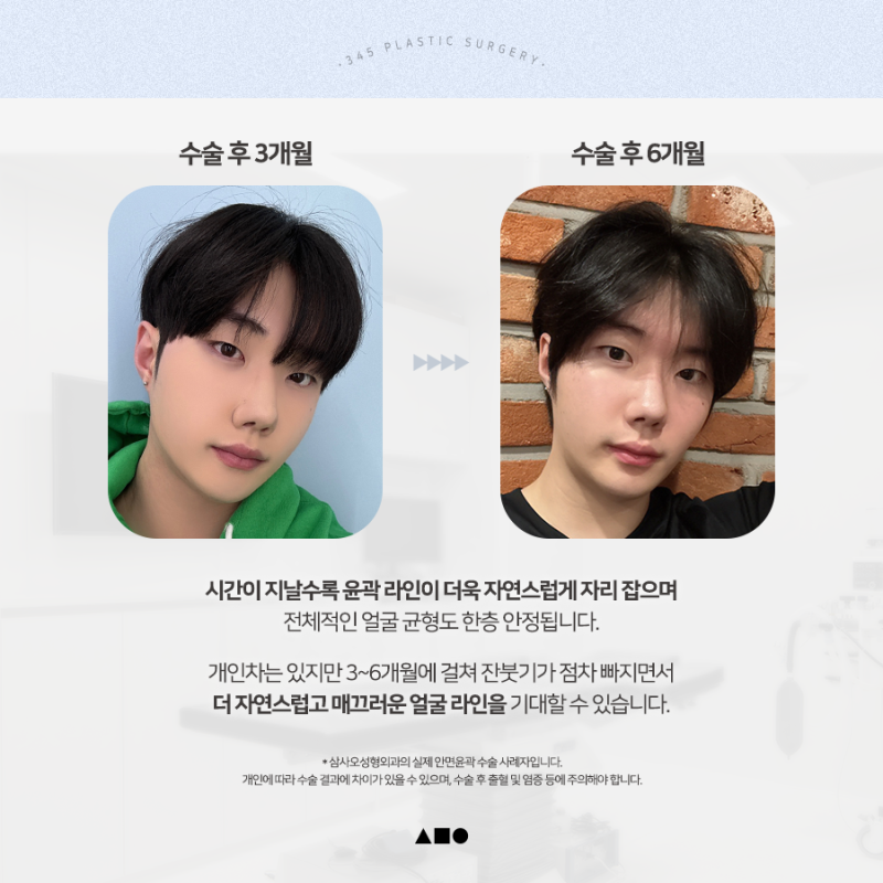 20대 남성 윤곽3종 후기, 붓기 변화 6개월 경과 사진 5