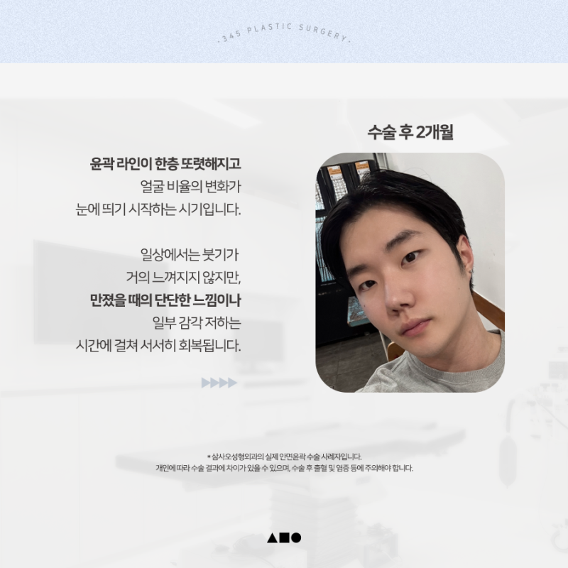 20대 남성 윤곽3종 후기, 붓기 변화 6개월 경과 사진 4