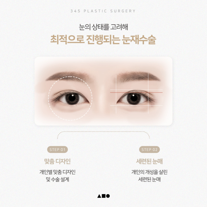 한쪽만 풀린 쌍꺼풀, 한쪽눈재수술로 가능할까요? 사진 4