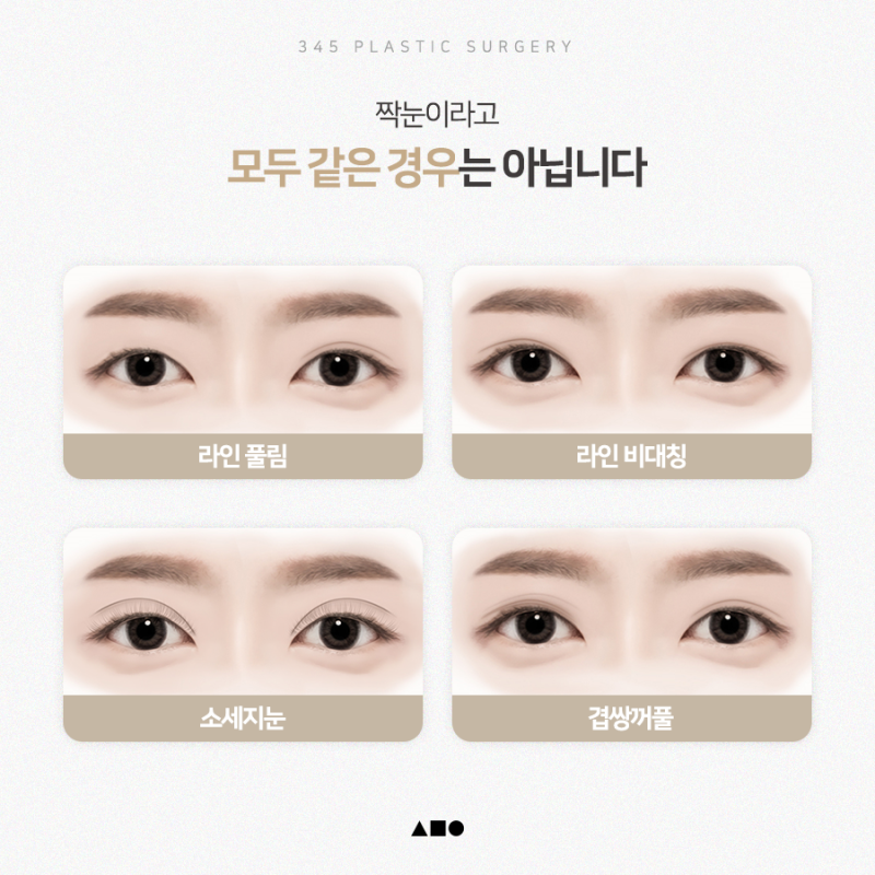 한쪽만 풀린 쌍꺼풀, 한쪽눈재수술로 가능할까요? 사진 3
