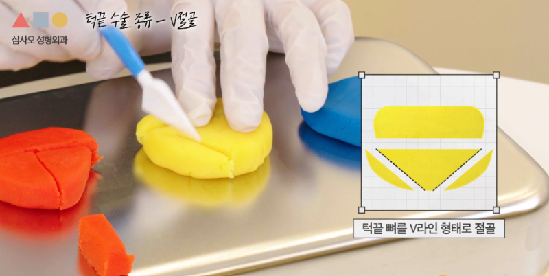 T절골? V절골? 나에게 더 적합한 앞턱수술 방법은? 사진 3