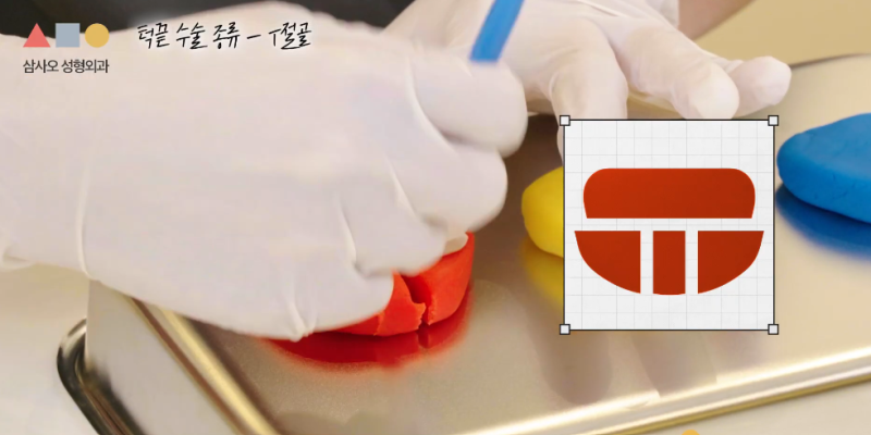 T절골? V절골? 나에게 더 적합한 앞턱수술 방법은? 사진 2