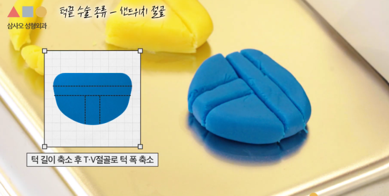 T절골? V절골? 나에게 더 적합한 앞턱수술 방법은? 사진 6