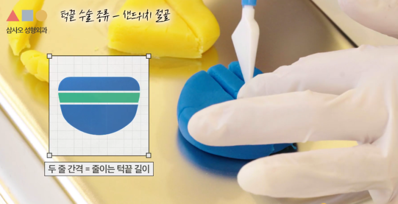 T절골? V절골? 나에게 더 적합한 앞턱수술 방법은? 사진 5