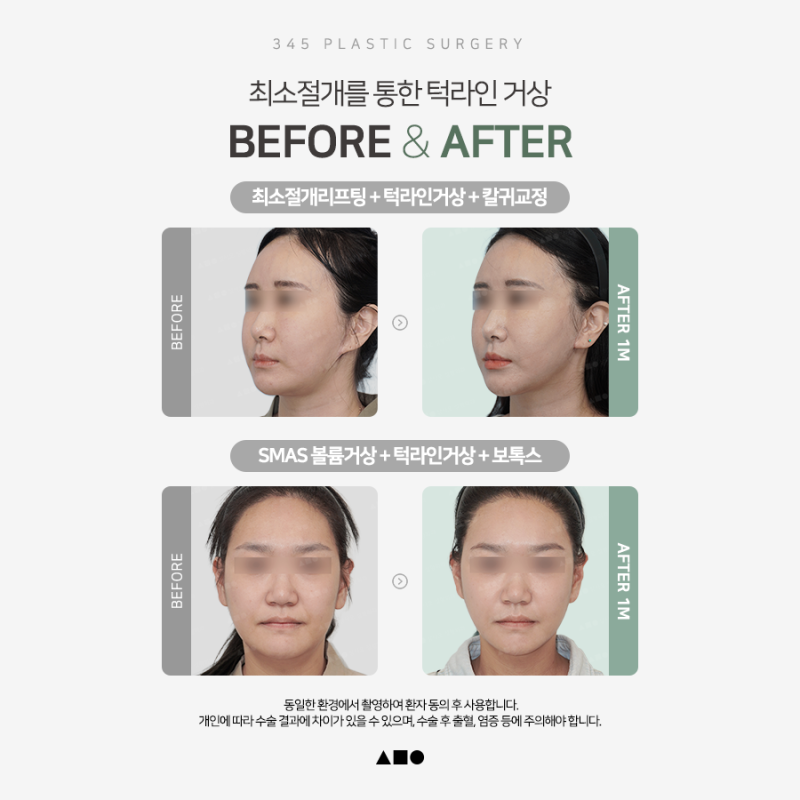 무너진 턱선을 자연스럽게, 턱라인거상 알아보기 사진 3