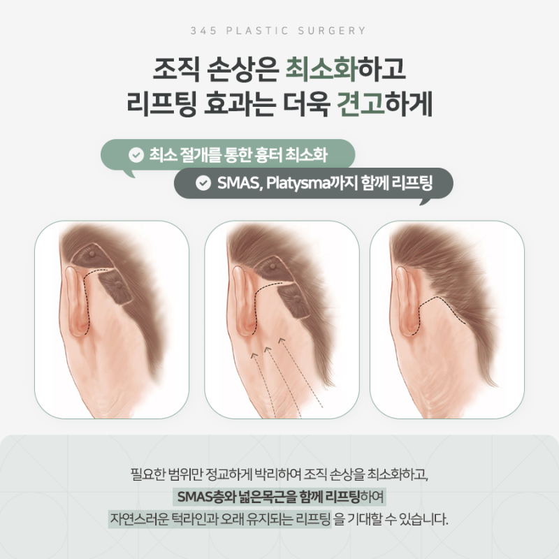 무너진 턱선을 자연스럽게, 턱라인거상 알아보기 사진 5