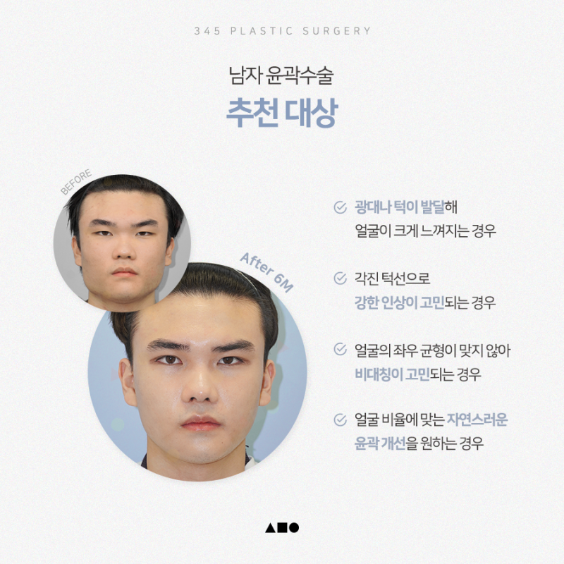 남자 윤곽수술, 자연스러운 얼굴 비율을 만드는 방법 사진 6