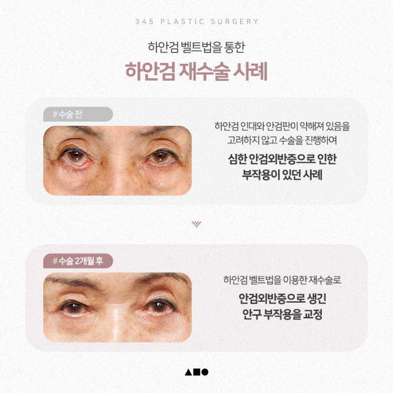 하안검 재수술, 더 신중한 접근이 필요한 이유 사진 4
