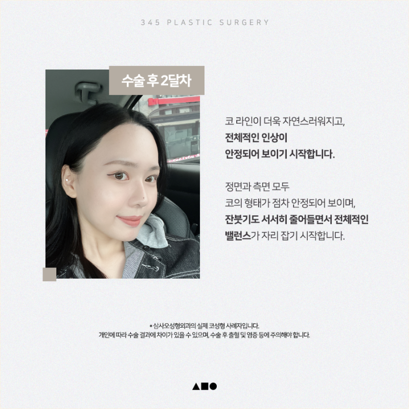 20대 여성 맞춤보형물 코성형 리얼 붓기 변화 사진 4