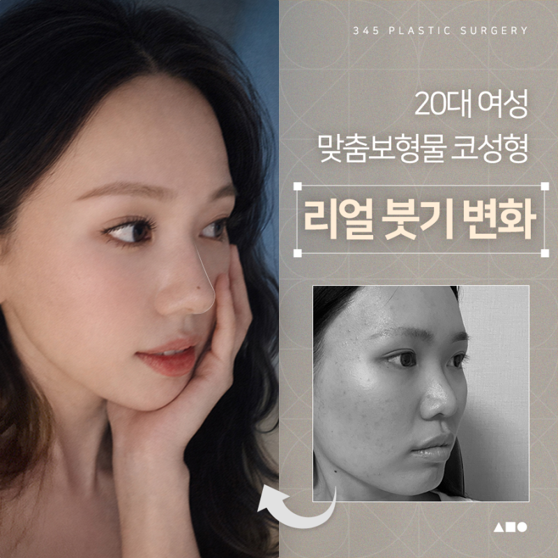 20대 여성 맞춤보형물 코성형 리얼 붓기 변화