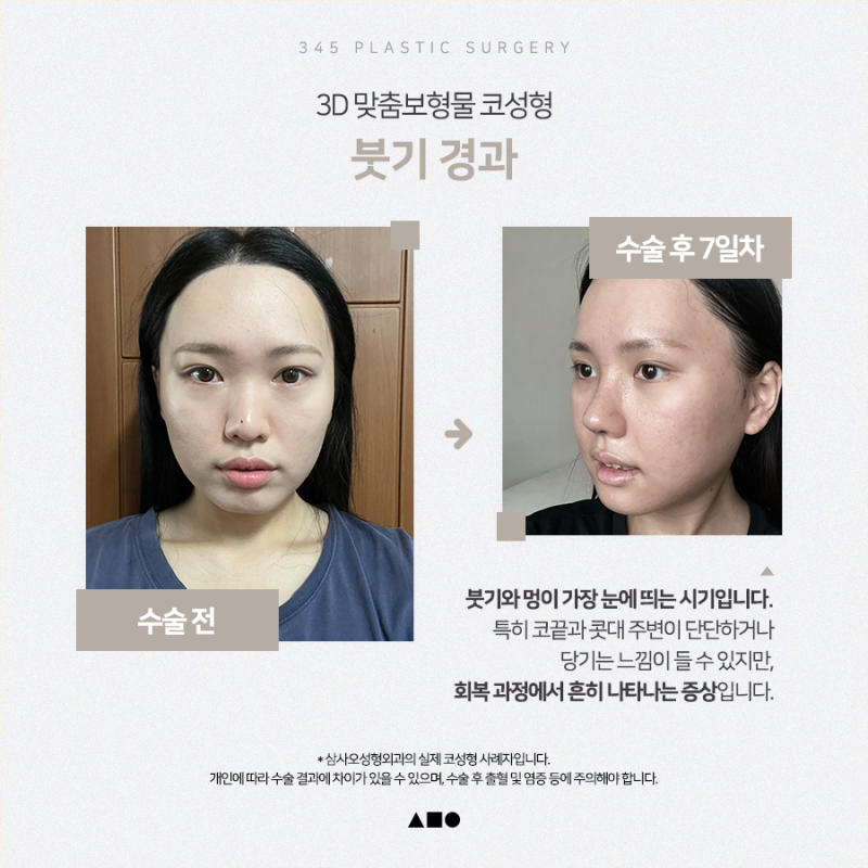 20대 여성 맞춤보형물 코성형 리얼 붓기 변화