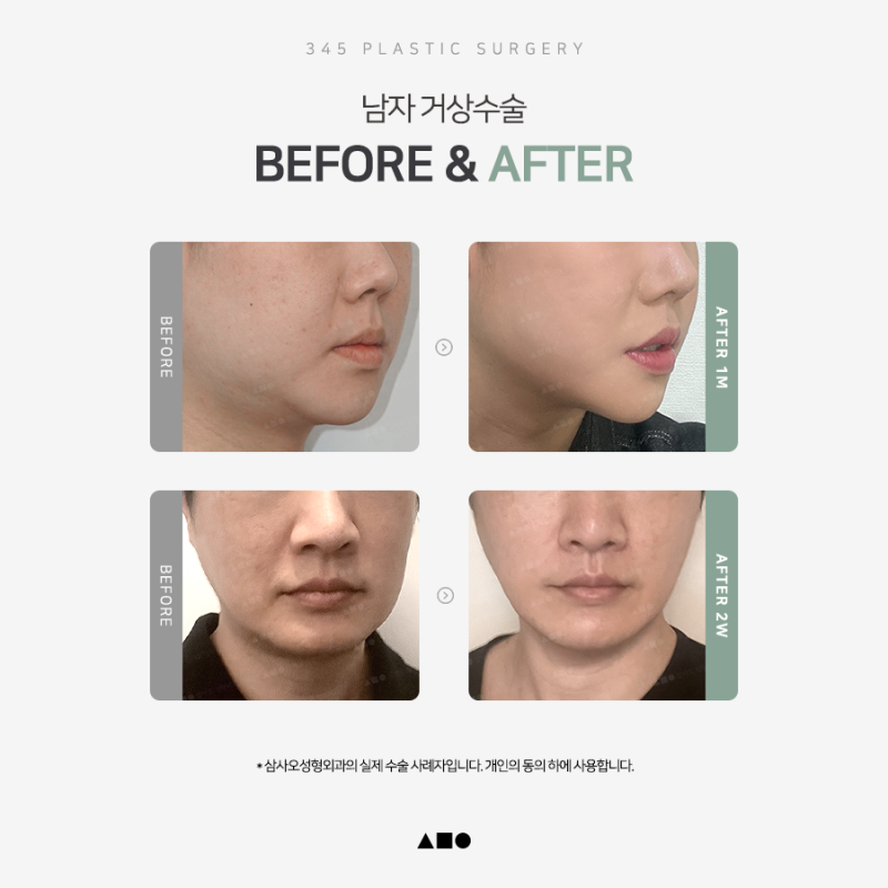남자 안면거상, 여성과 무엇이 다를까요? 사진 6