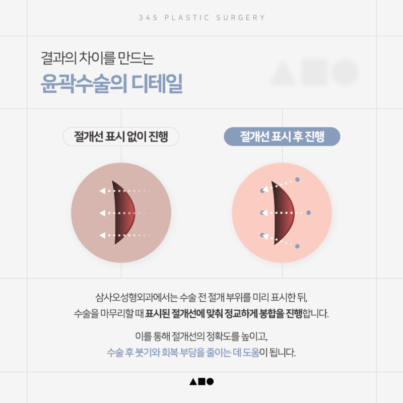 광대, 사각턱, 턱끝까지 함께 고려해야 하는 이유? 삼사오 윤곽 3종 사진 7