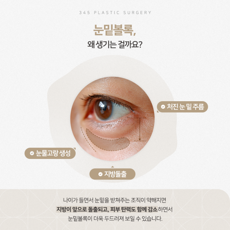 눈밑볼록이 심해지는 이유? 하안검 vs 눈밑지방재배치 사진 2
