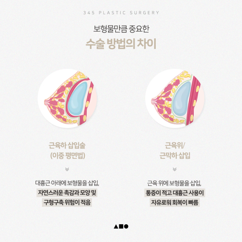모티바 가슴성형, 자연스러운 볼륨의 비결은? 사진 6