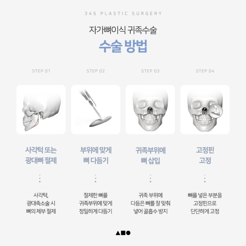 팔자주름 개선을 위한 자가뼈이식 귀족수술 사진 5