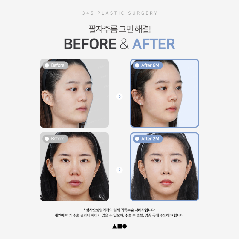 팔자주름 개선을 위한 자가뼈이식 귀족수술 사진 3