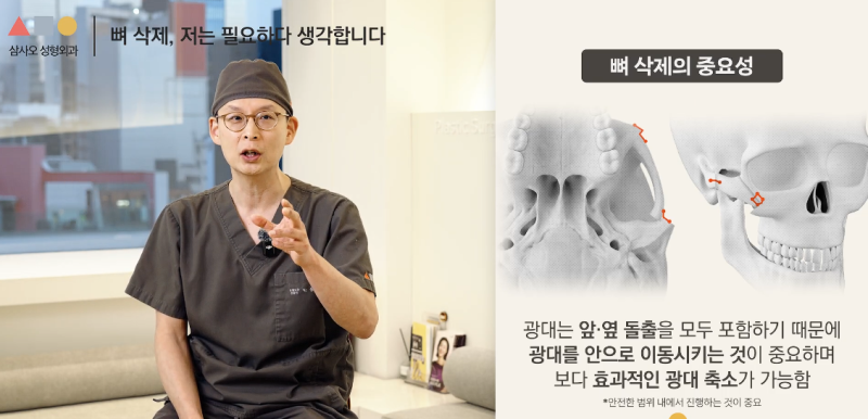 광대축소술, 절골 방식이 결과를 좌우합니다 사진 5