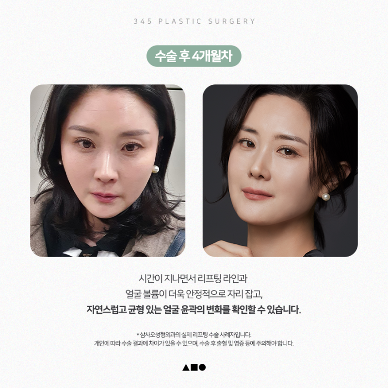안면거상, 얼굴지방재배치 후 1개월부터 4개월까지 리얼 붓기 변화 사진 5