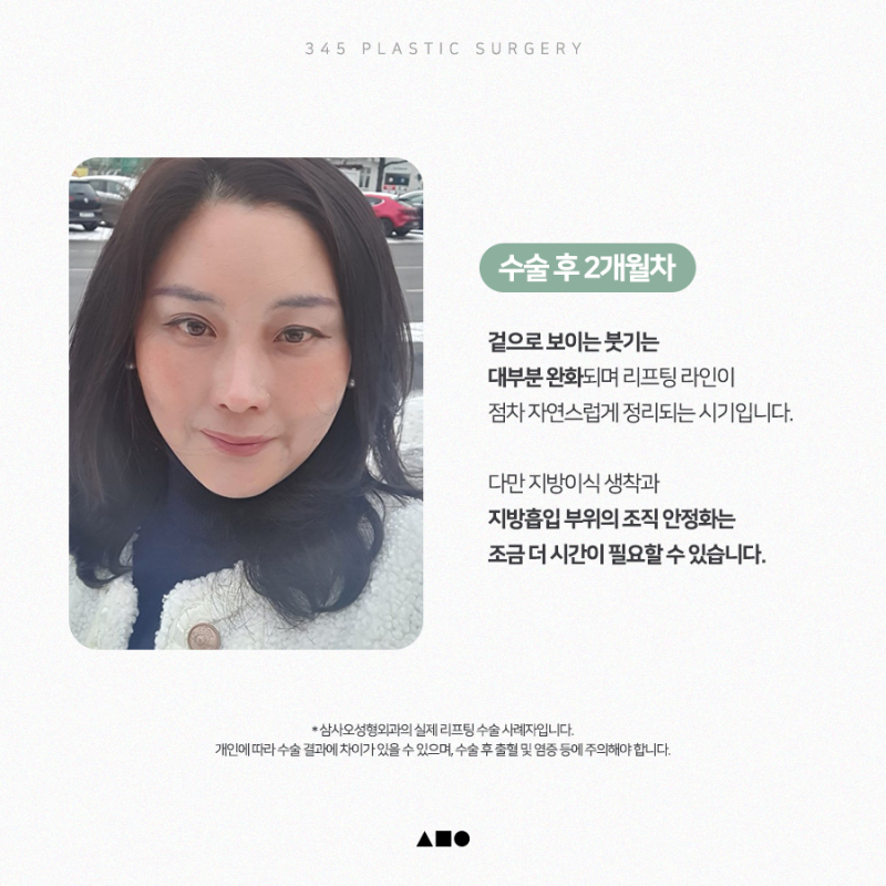 안면거상, 얼굴지방재배치 후 1개월부터 4개월까지 리얼 붓기 변화 사진 3