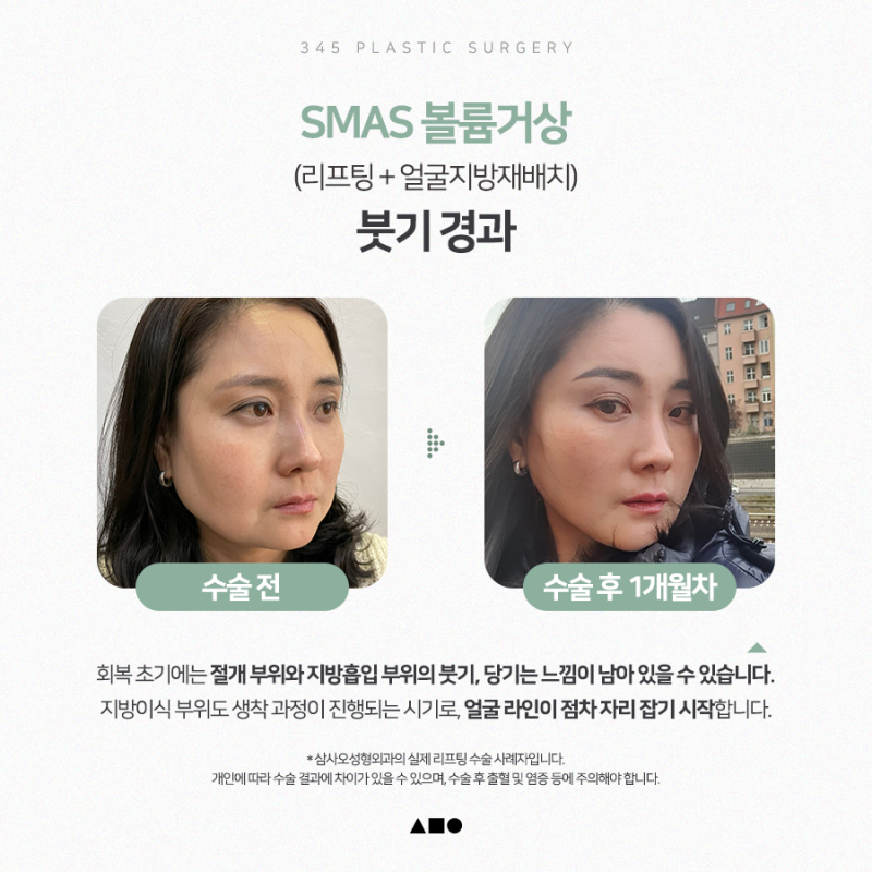 안면거상, 얼굴지방재배치 후 1개월부터 4개월까지 리얼 붓기 변화 사진 2
