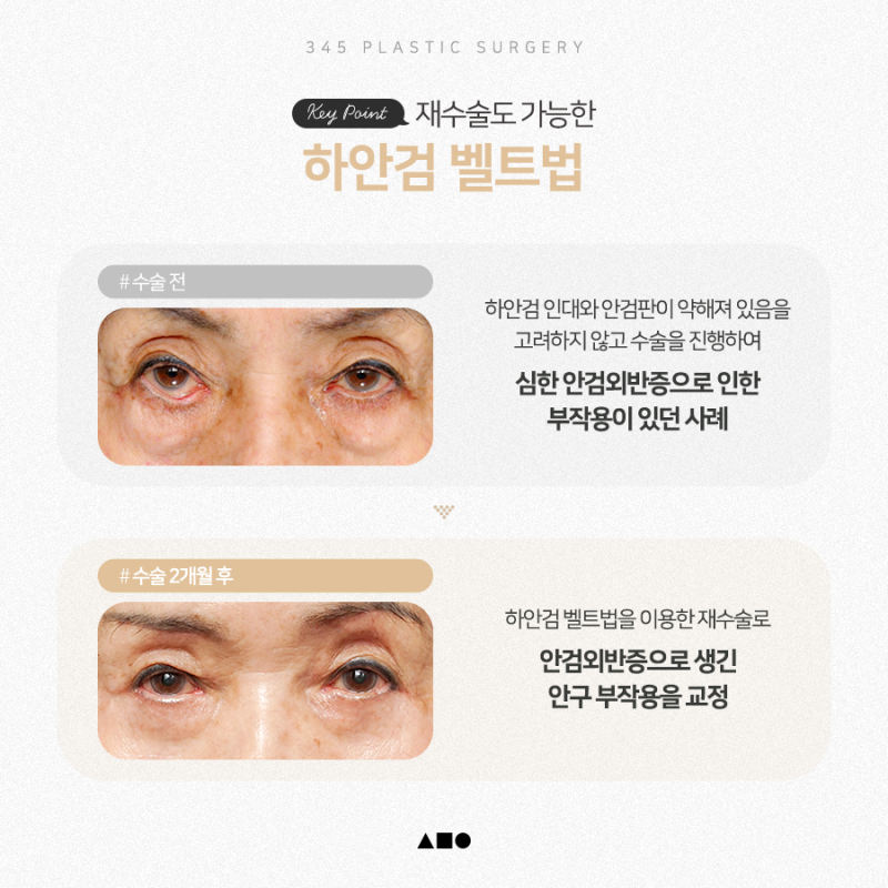 내 눈에 필요한 건 상안검일까, 하안검일까? 사진 6