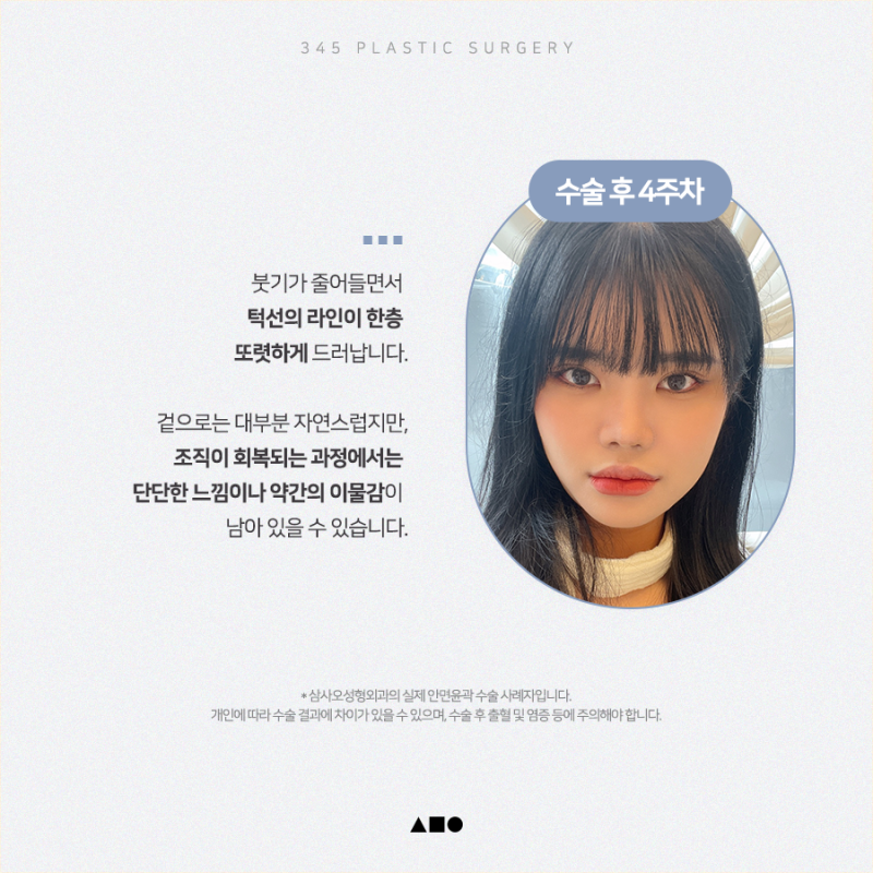20대 여성 윤곽 2종(사각턱, 앞턱) 리얼 붓기 변화 사진 4