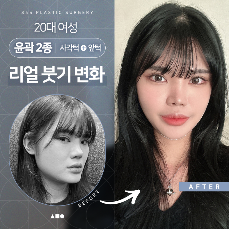 20대 여성 윤곽 2종(사각턱, 앞턱) 리얼 붓기 변화