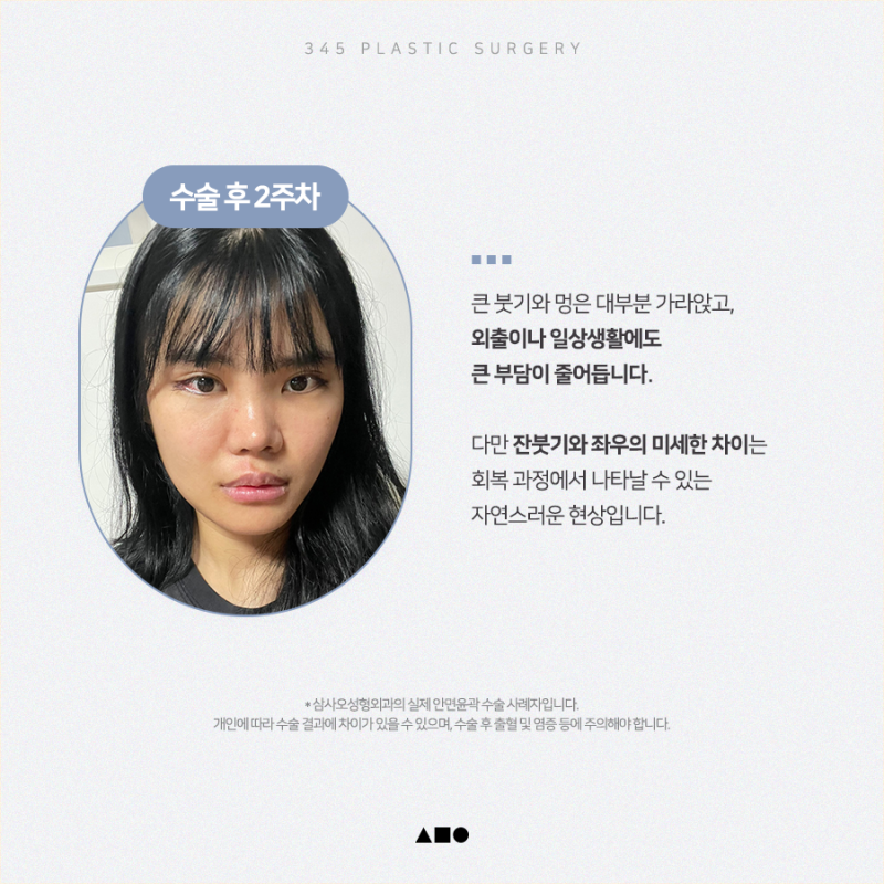 20대 여성 윤곽 2종(사각턱, 앞턱) 리얼 붓기 변화 사진 3