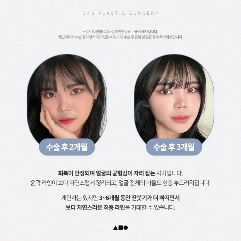 20대 여성 윤곽 2종(사각턱, 앞턱) 리얼 붓기 변화 사진 5
