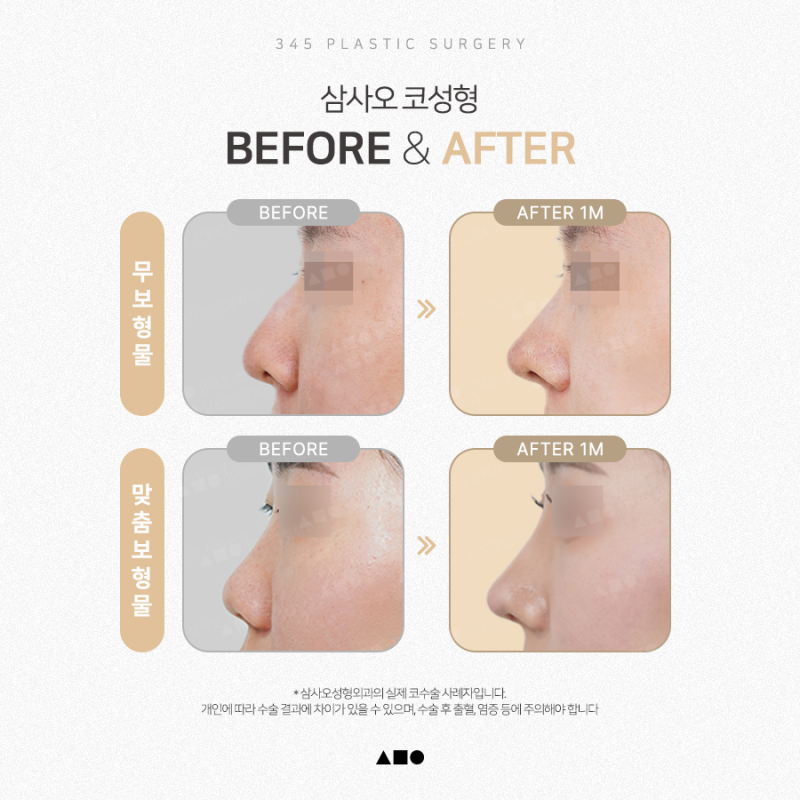 무보형물 코성형 vs 맞춤보형물, 내 코에는 어떤 방법이 맞을까? 사진 2