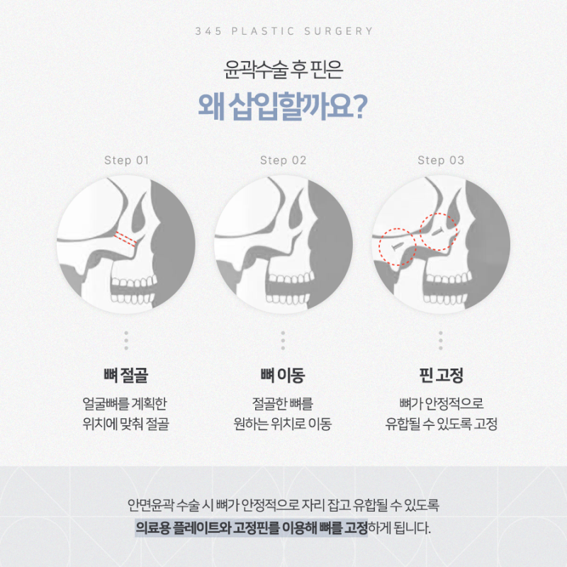 윤곽수술 핀제거, 이 기간 안에 하셔야 합니다