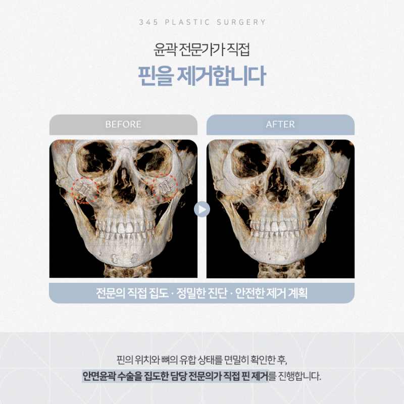 윤곽수술 핀제거, 이 기간 안에 하셔야 합니다 사진 4